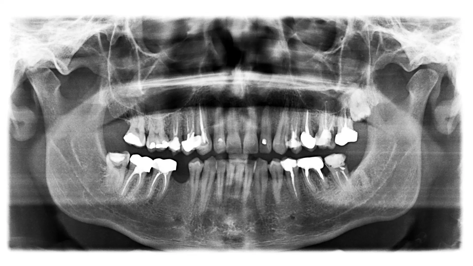 Digital dental x-ray panoramic display